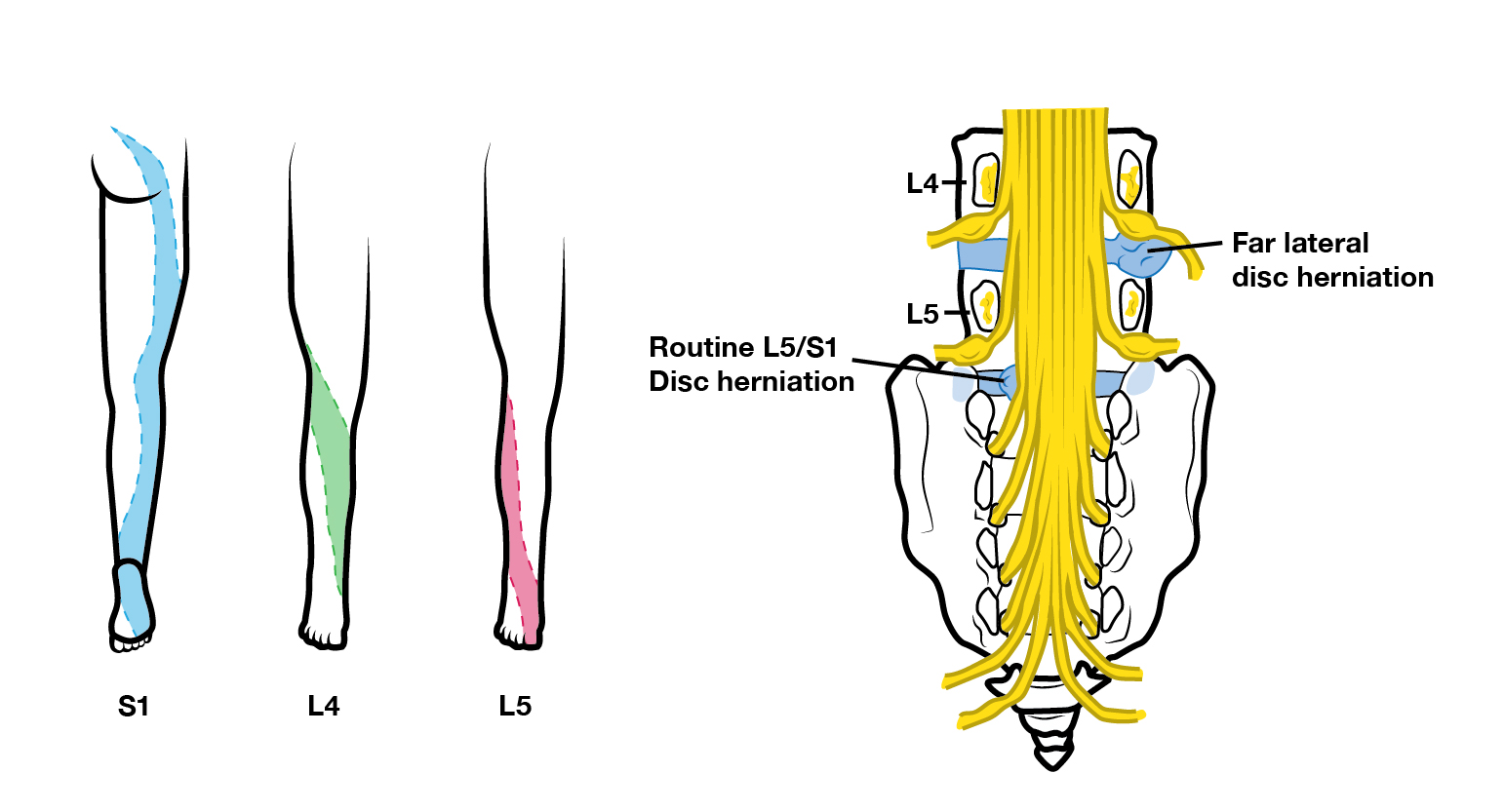 Lumbar Nerve Root Disorder Radiculopathy Symptoms Causes Lumbar Nerve Root Disorder Radiculopathy Symptoms Causes