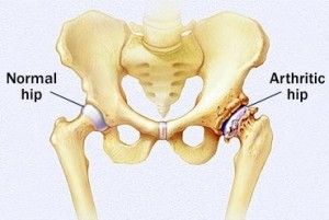 arthritis-hip2