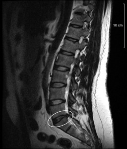 Spinal-disc-protrusion-l5