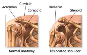 dislocated-shoulder1
